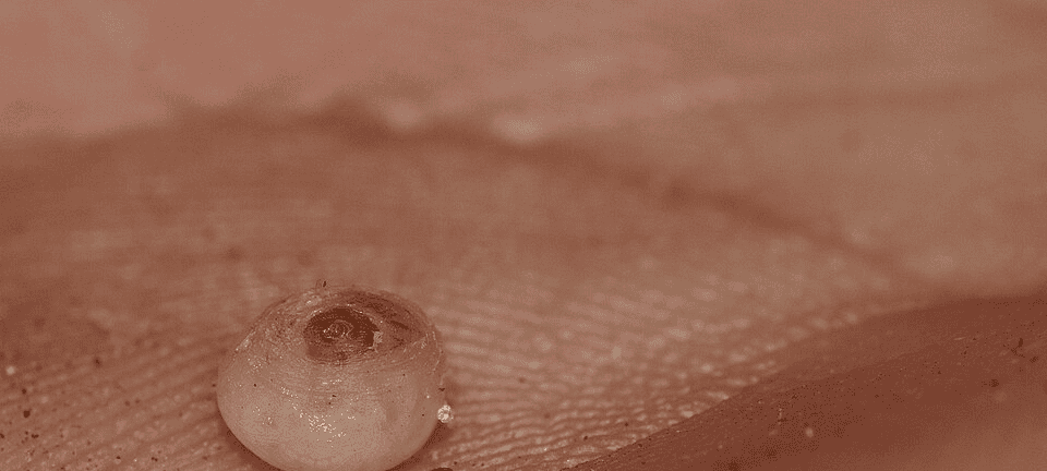 Bicho de pé: veja como identificar e remover o parasita antes de complicar - Imagem do artigo original